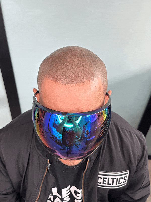 Scalp Micropigmentation creating the appearance of fuller hair density for a male client near Boston