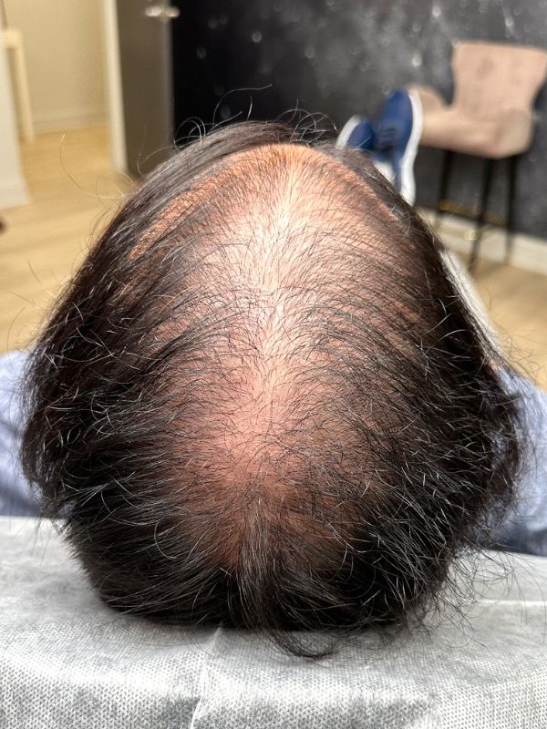 Before SMP density fill with visible scalp through thinning hair