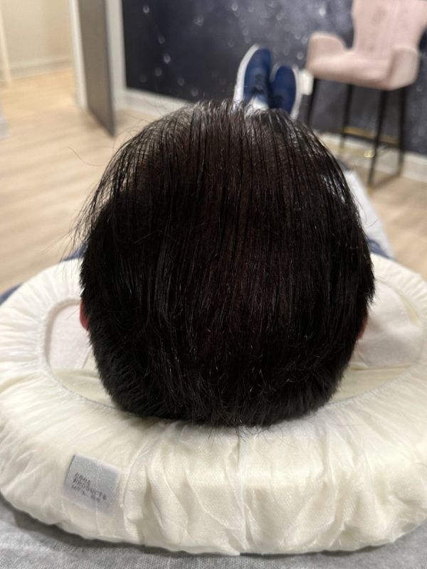 After SMP density fill with reduced visible scalp contrast