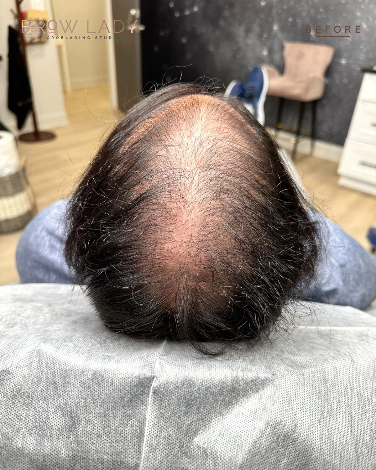 BEFORE SMP Density Fill result by Bik Shrestha at Brow Lady near Boston