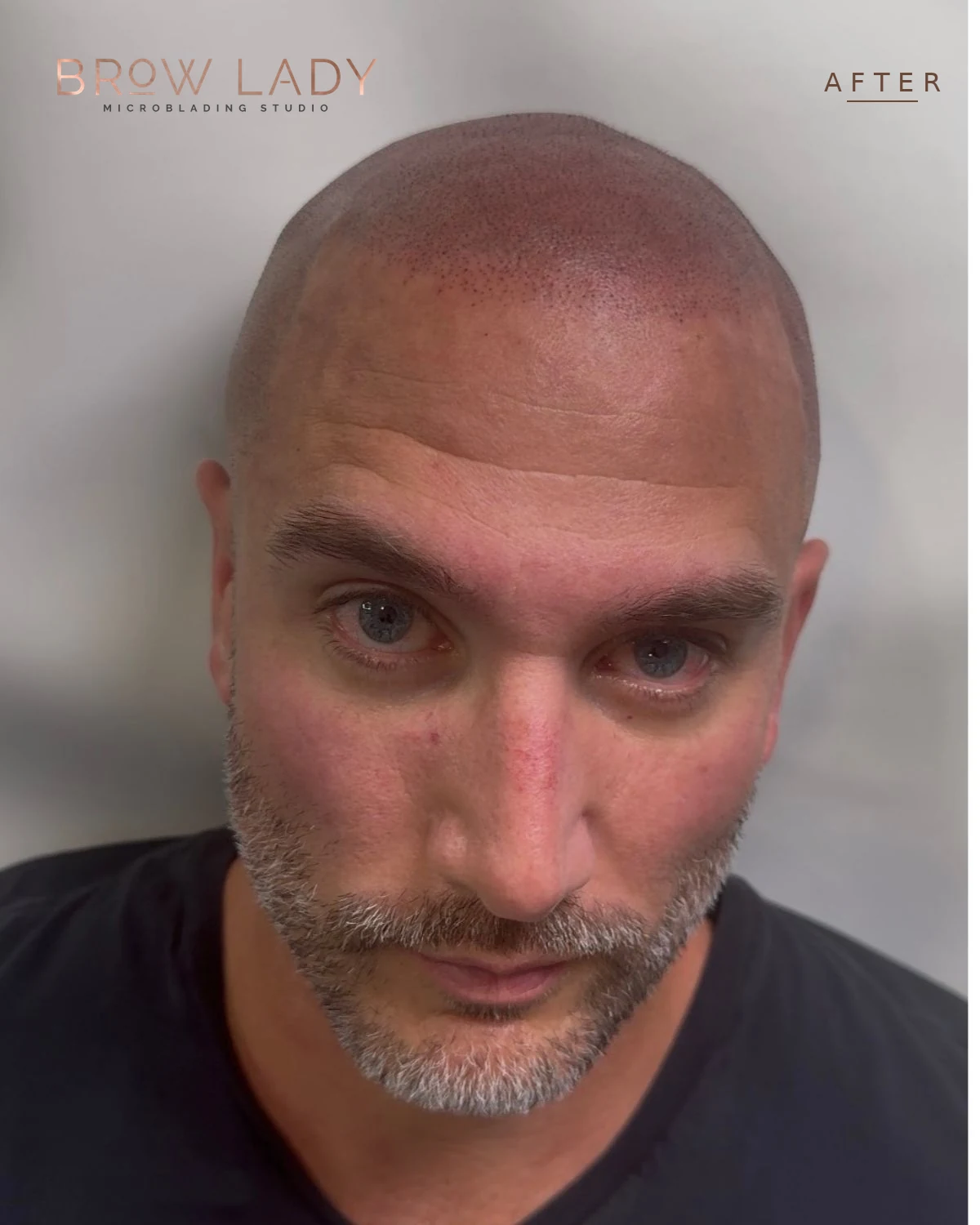 AFTER Scalp Micropigmentation result by Bik Shrestha at Brow Lady near Boston