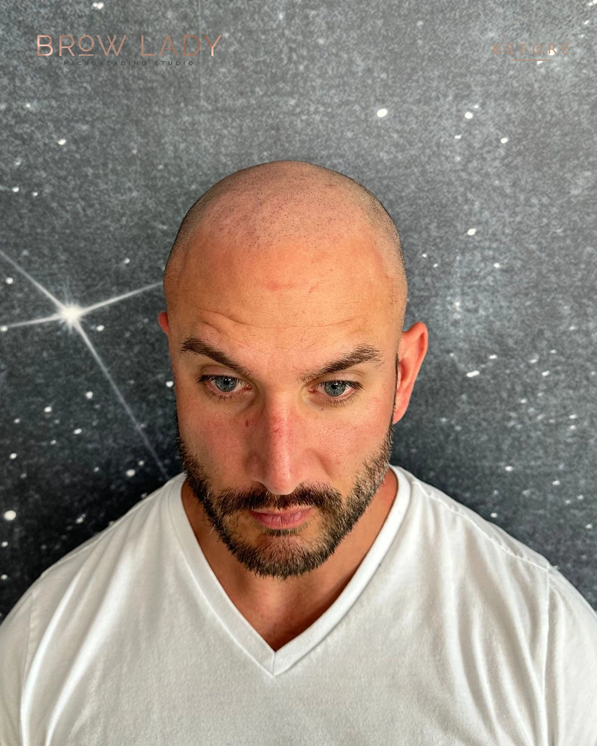 BEFORE Scalp Micropigmentation result by Bik Shrestha at Brow Lady near Boston