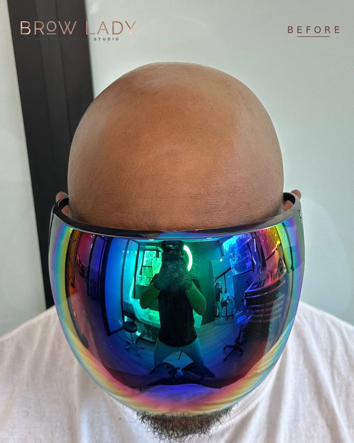 BEFORE Scalp Micropigmentation result by Bik Shrestha at Brow Lady near Boston