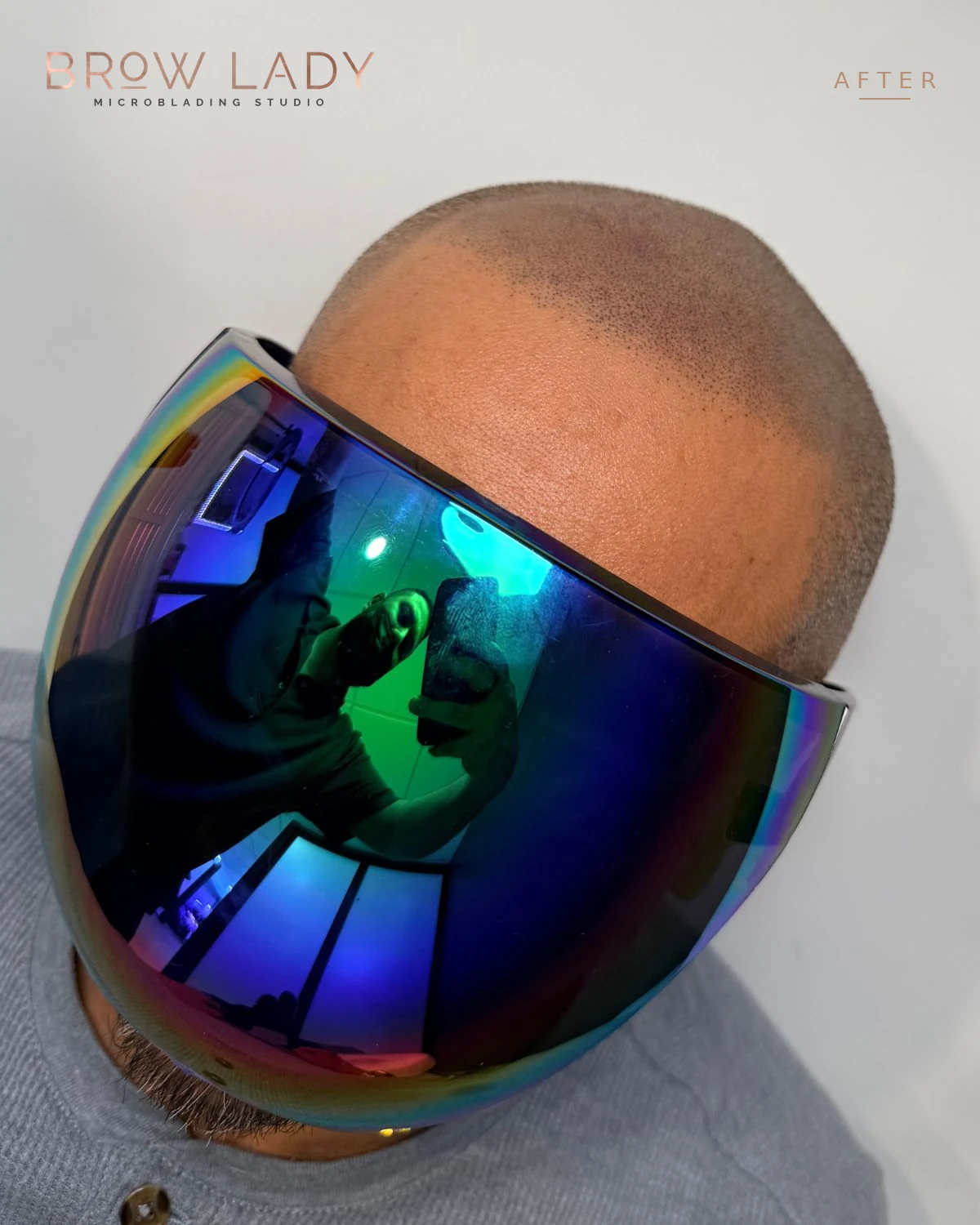 AFTER Scalp Micropigmentation result by Bik Shrestha at Brow Lady near Boston
