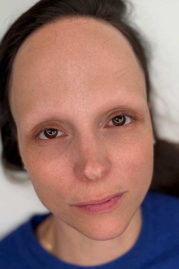 Before — Alopecia client with no brows