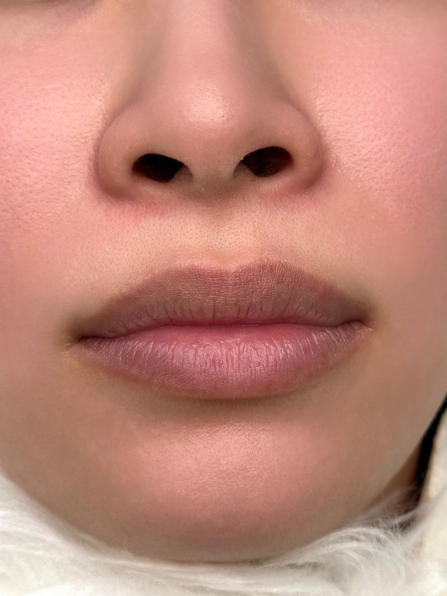 Before Lip Blush treatment in Wilmington, Massachusetts