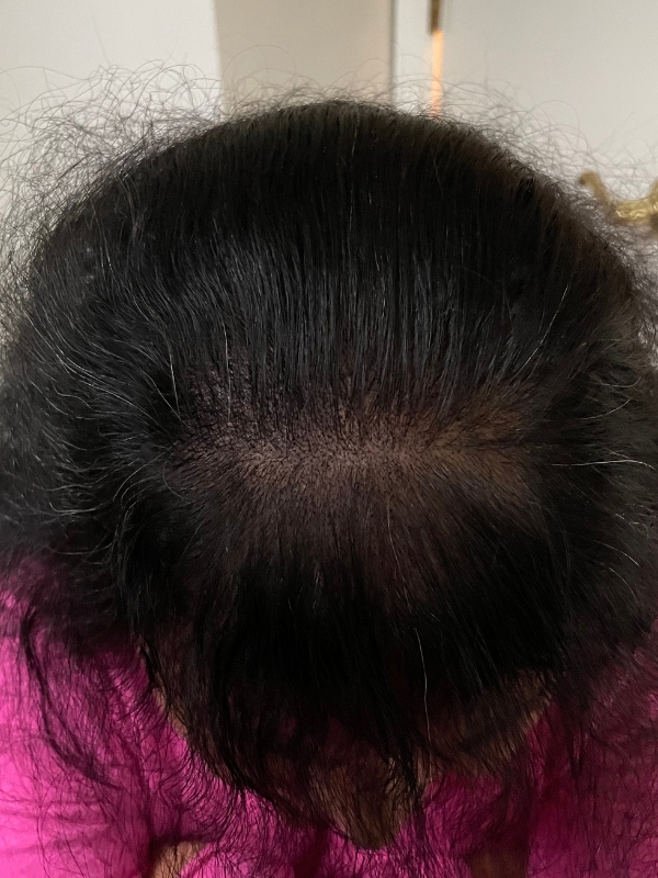 After SMP density fill treatment for thinning hair near Boston