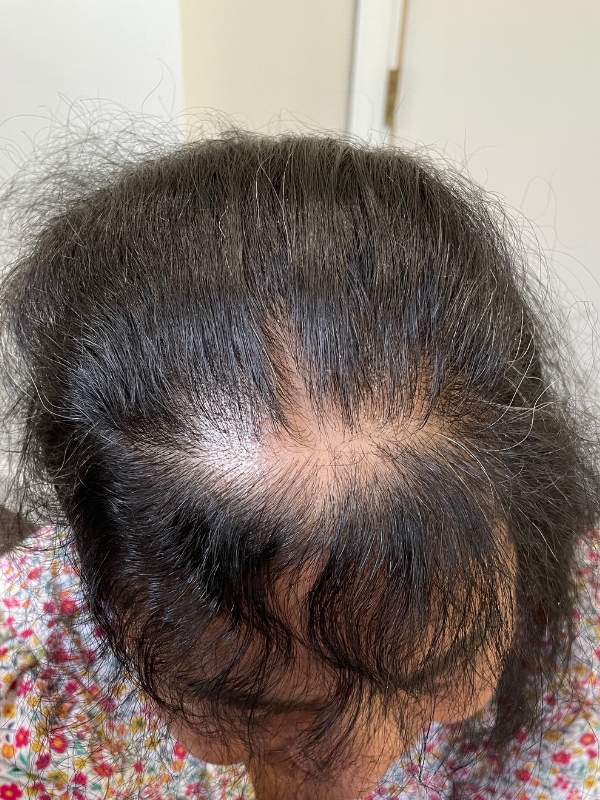 Before SMP density fill for thinning hair near Boston