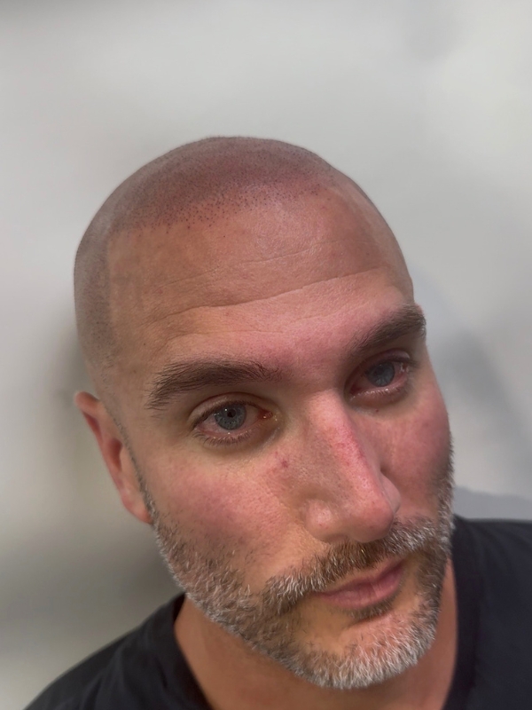 After scalp micropigmentation following a hair transplant near Boston
