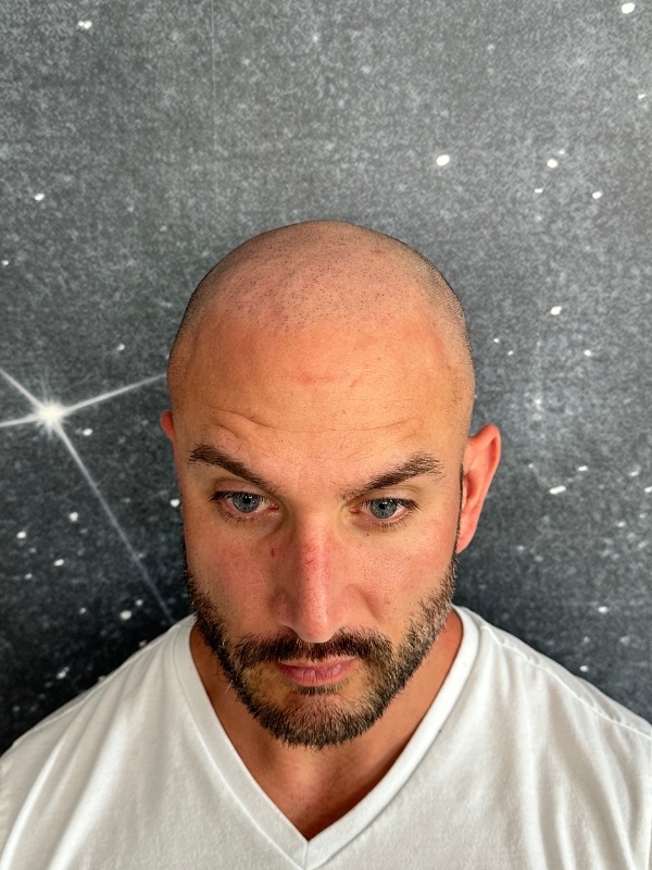 Before scalp micropigmentation following a hair transplant near Boston